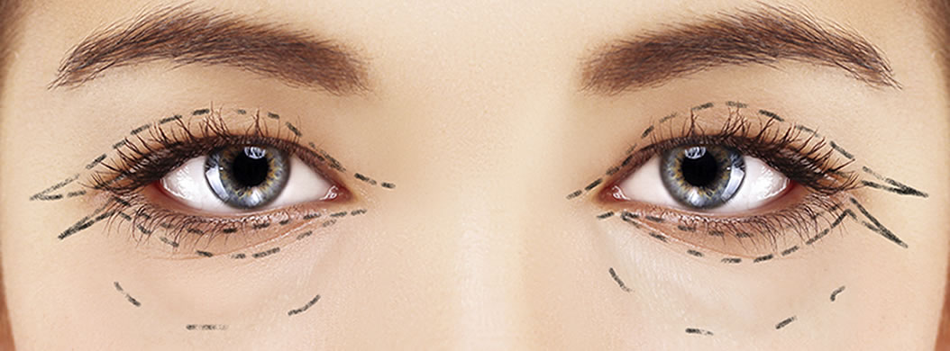 define blepharoplasty