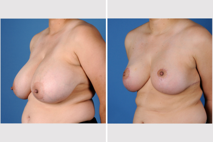 Before Image: Breast Reduction - front