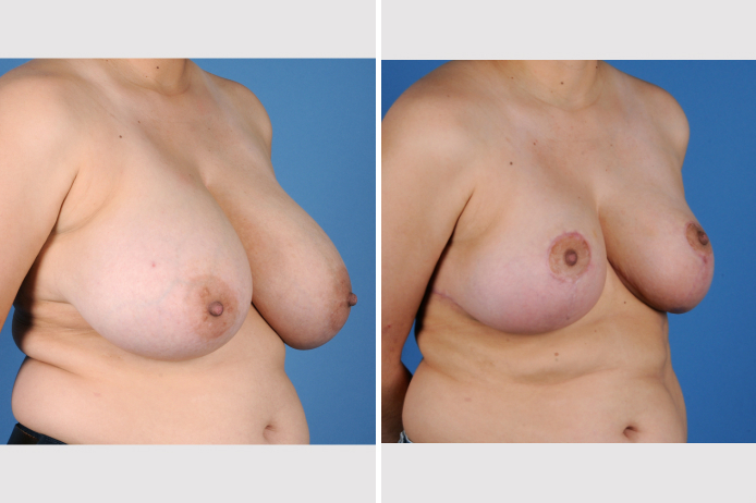 Before Image: Breast Reduction - front