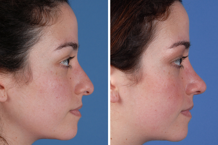Before Image: Primary Rhinoplasty - front