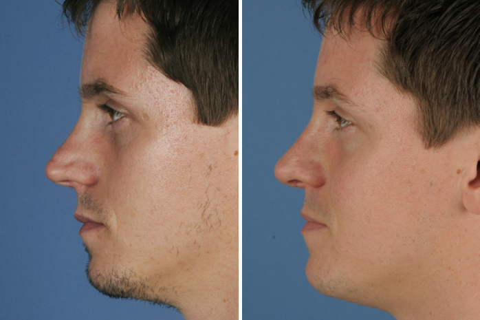 Before Image: Primary Rhinoplasty - front