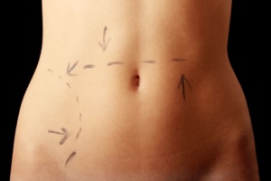 Tummy Tuck