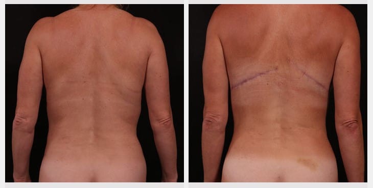 Bra Strap Excision - Andrew Trussler, MD PLLC