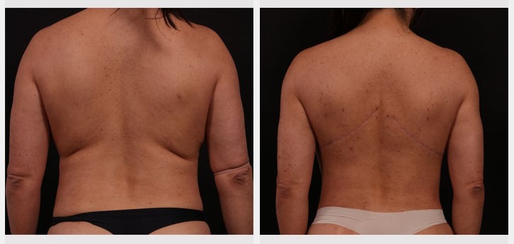 Bra Strap Excision - Andrew Trussler, MD PLLC