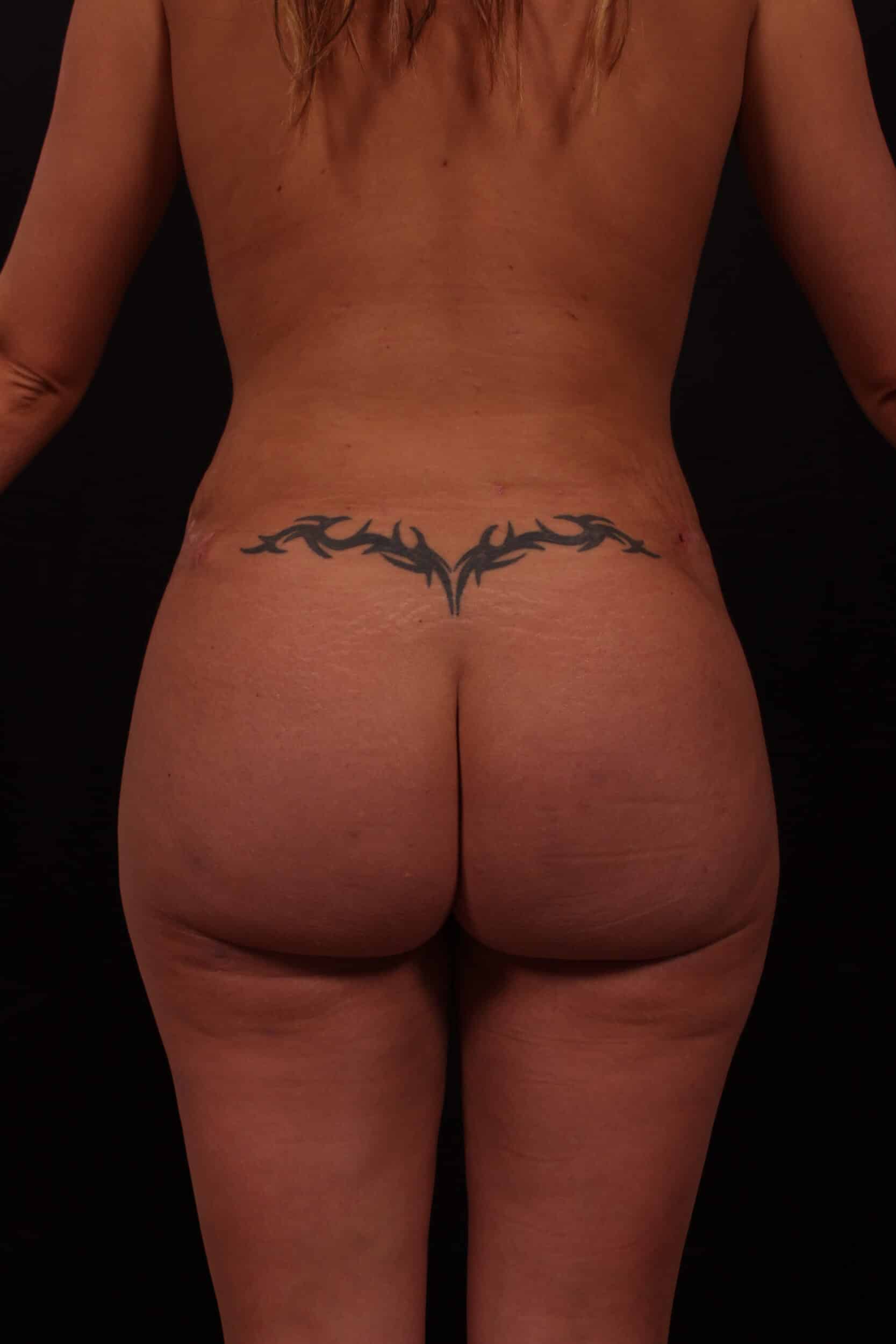 20160824155050577 20161020153918971 after Brazilian Butt Lift Austin TX