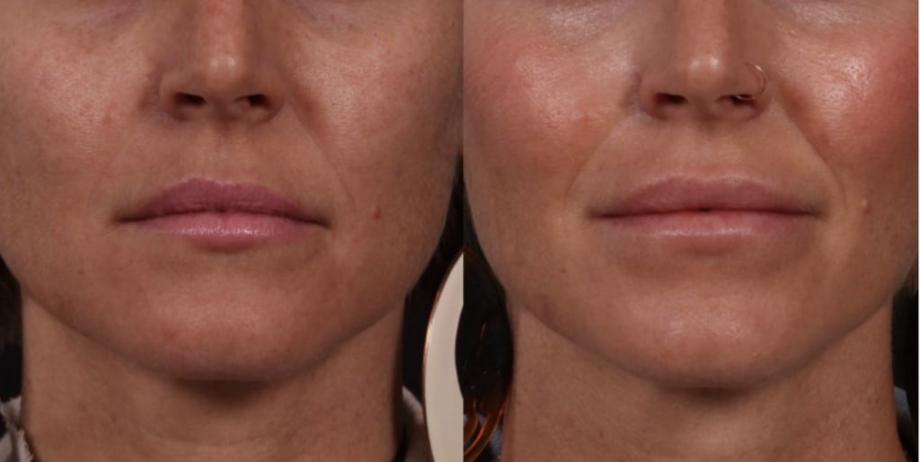 before and after Lip Augmentation Bee Cave TX