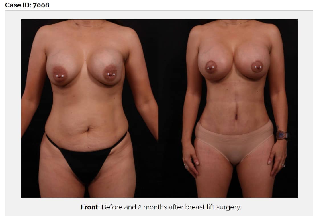 topless woman before and after mommy makeover, stomach flatter and breasts lifted after procedure