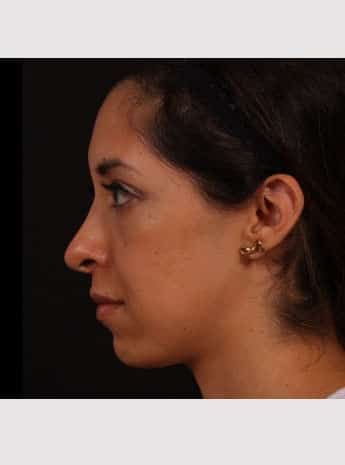 After Image: Rhinoplasty and Chin Implant - left-side