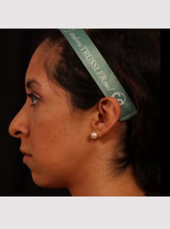 Before Image: Rhinoplasty and Chin Implant - left-side
