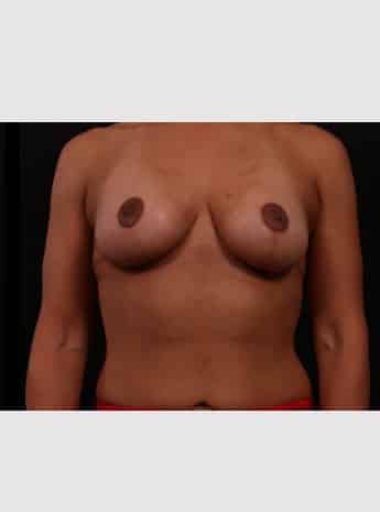 After Image: Breast Reduction - front