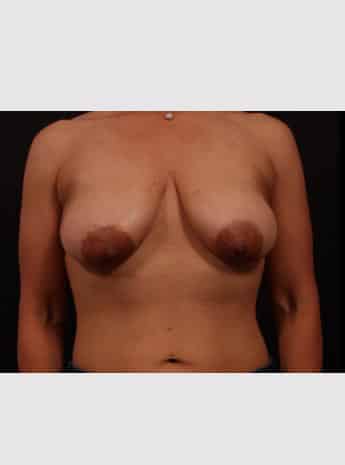 Before Image: Breast Reduction - front