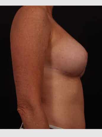 After Image: Breast Reduction - right-side