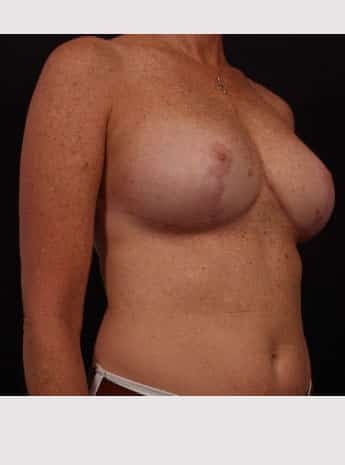 After Image: Breast Reduction - right-front-oblique