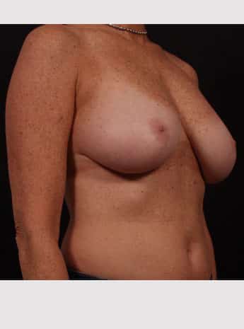 Before Image: Breast Reduction - right-front-oblique