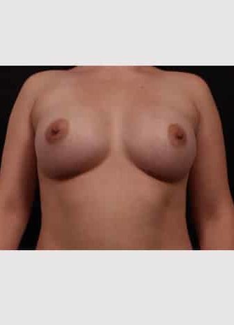 After Image: Breast Augmentation - front
