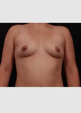 Before Image: Breast Augmentation - front