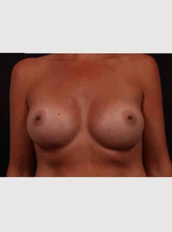 After Image: Breast Augmentation - front