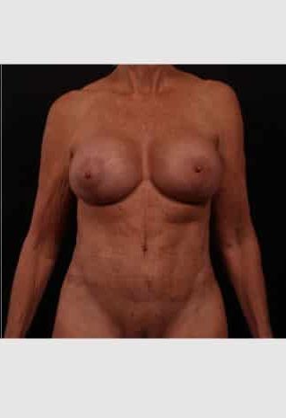 After Image: Mommy Makeover - front