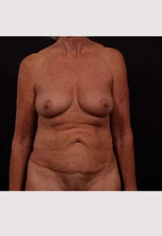Before Image: Mommy Makeover - front