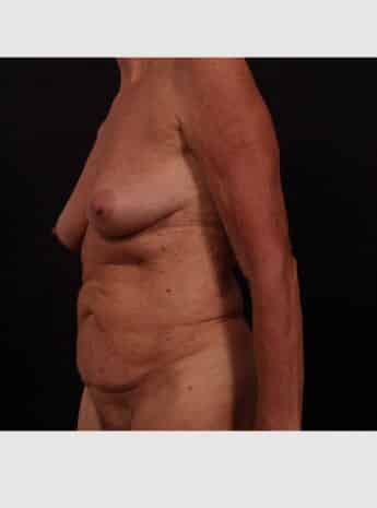 Before Image: Mommy Makeover - left-front-oblique