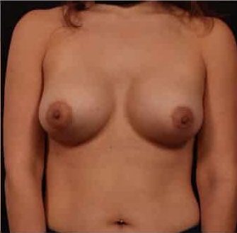 After Image: Breast Augmentation - front