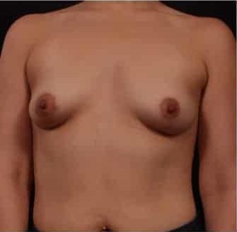 Before Image: Breast Augmentation - front