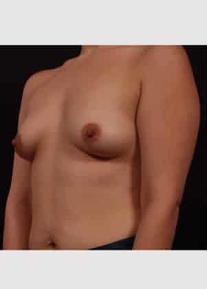 Before Image: Breast Augmentation - left-front-oblique