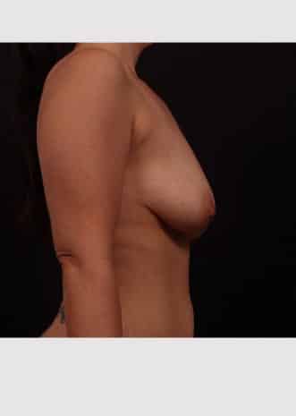 Before Image: Breast Lift with Augmentation - right-side