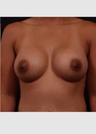 After Image: Breast Augmentation - front