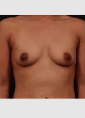 Before Image: Breast Augmentation - front