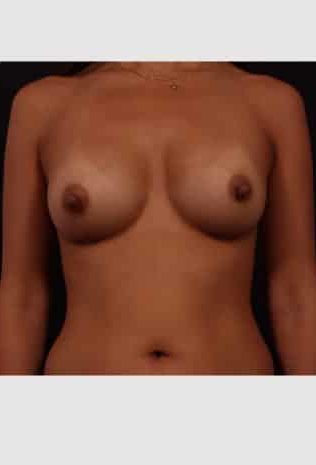 After Image: Breast Augmentation - front