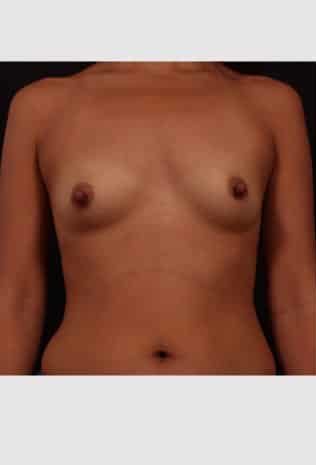Before Image: Breast Augmentation - front