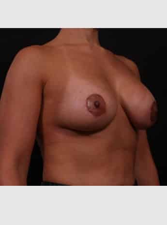 After Image: Periareolar Lift (Mastopexy) with Augmentation - right-front-oblique
