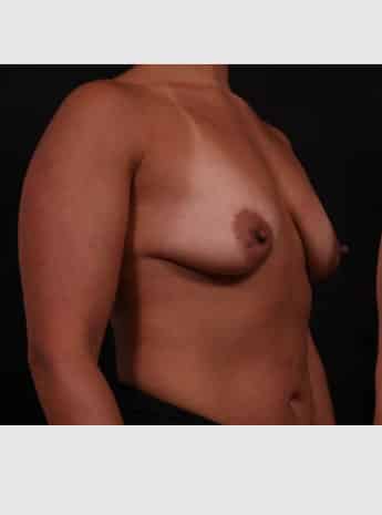 Before Image: Periareolar Lift (Mastopexy) with Augmentation - right-front-oblique