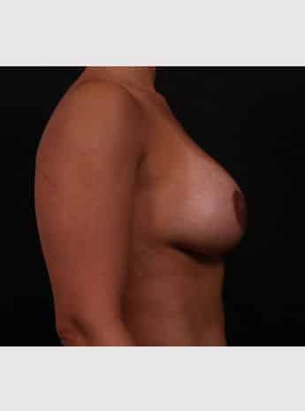 After Image: Periareolar Lift (Mastopexy) with Augmentation - right-side