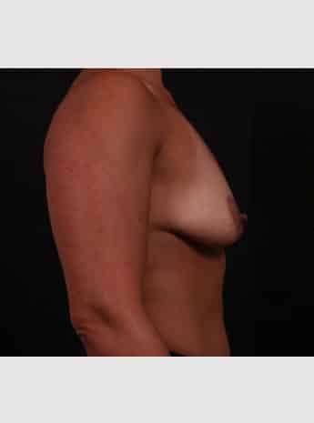 Before Image: Periareolar Lift (Mastopexy) with Augmentation - right-side