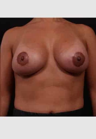 After Image: Periareolar Lift (Mastopexy) with Augmentation - front