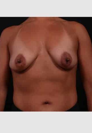 Before Image: Periareolar Lift (Mastopexy) with Augmentation - front