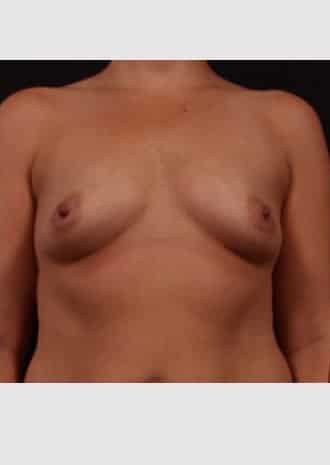 Before Image: Breast Augmentation - front