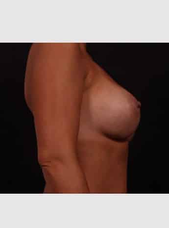 After Image: Breast Augmentation - right-side