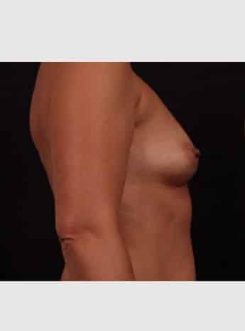 Before Image: Breast Augmentation - right-side
