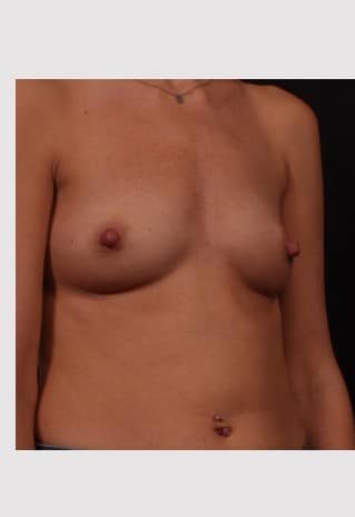 Before Image: Breast Augmentation - right-front-oblique