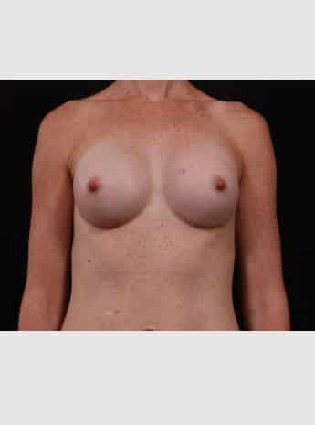 After Image: Breast Augmentation - front