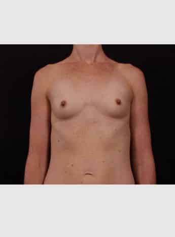 Before Image: Breast Augmentation - front