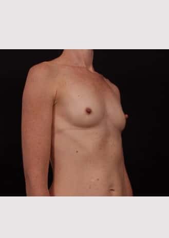Before Image: Breast Augmentation - right-front-oblique