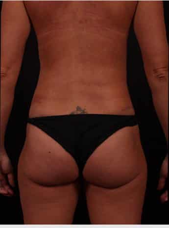 After Image: Mommy Makeover - back