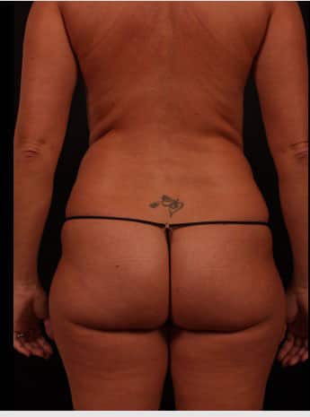 Before Image: Mommy Makeover - back