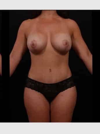 After Image: Mommy Makeover - front