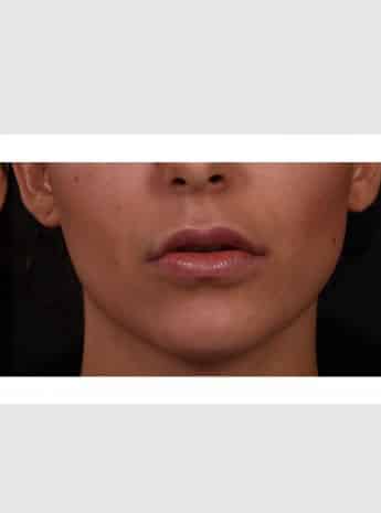 After Image: Fat Grafting to Lips - front