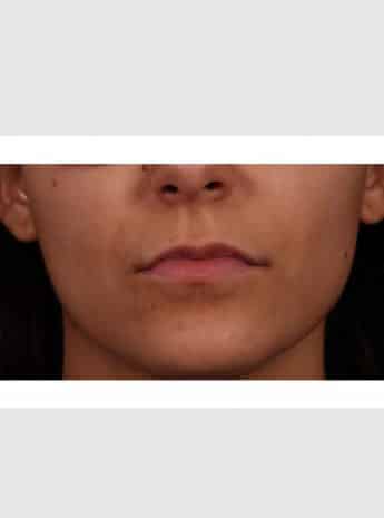 Before Image: Fat Grafting to Lips - front